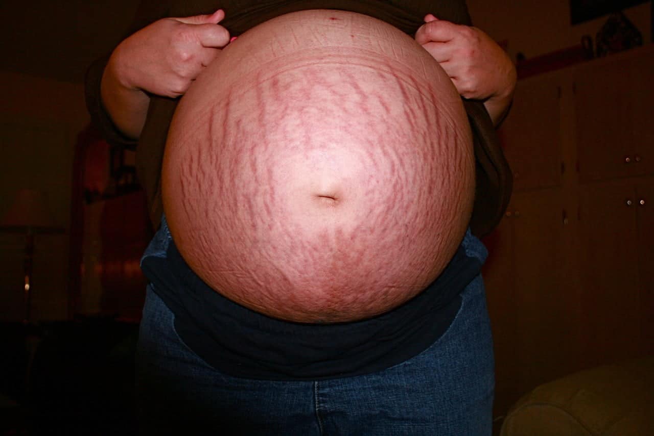 dream meaning Stretch marks
